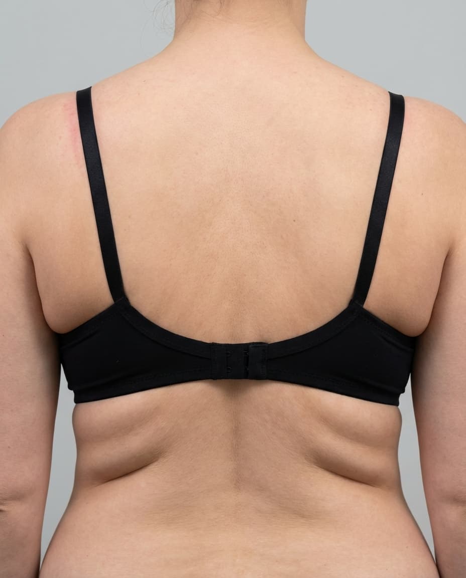 Before Tumescent Liposuction on upper back & bra line — Female patient, age 38