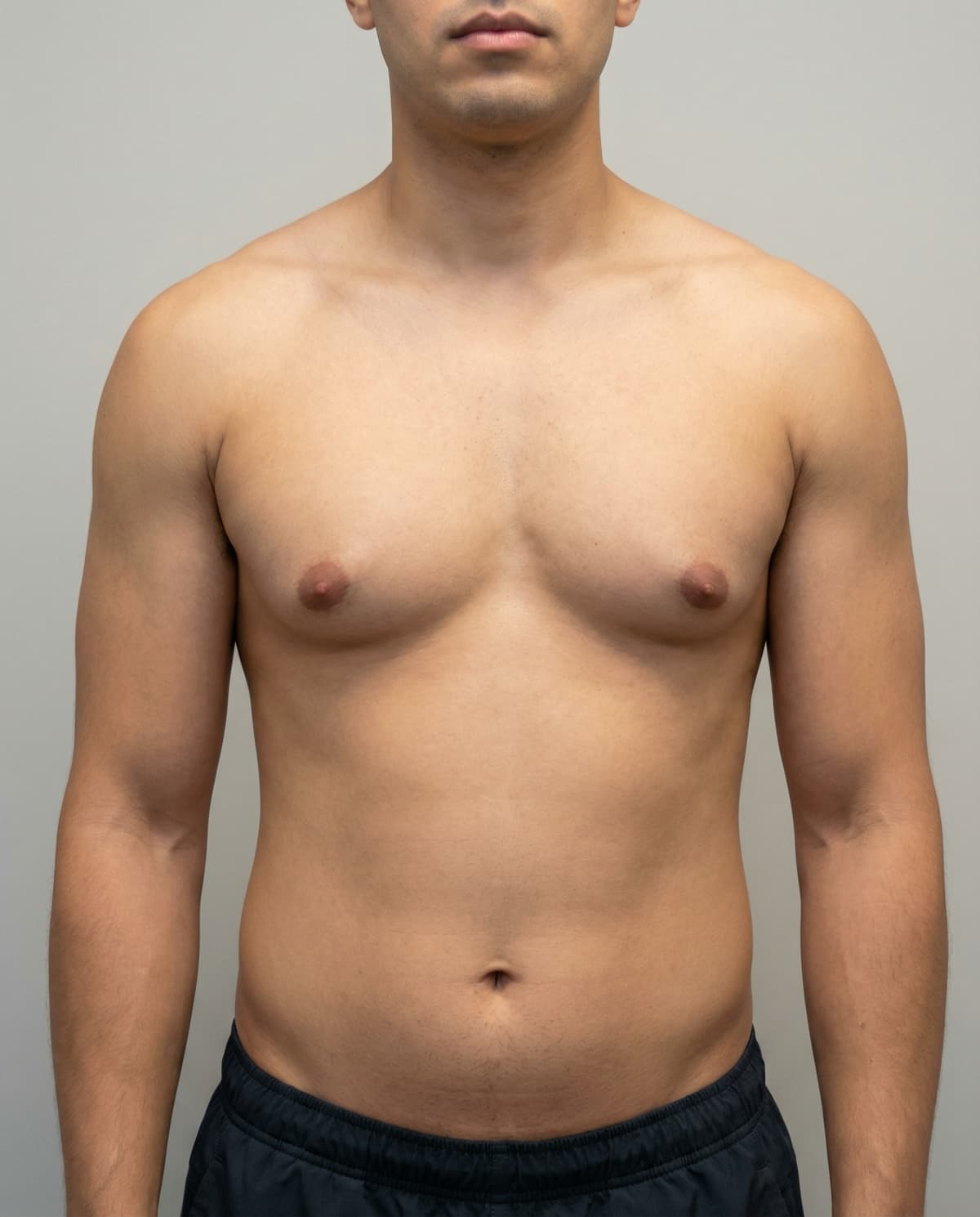 After Power-Assisted Liposuction on flanks & lower back — Male patient, age 34, 6 months post-op