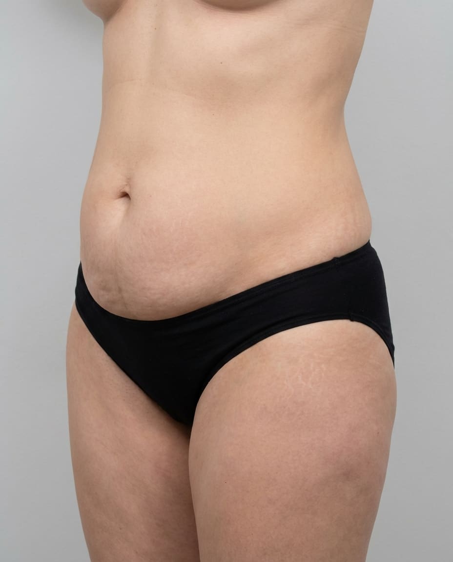 liposuction complication rates from 246,119-procedure national analysis: frequency by complication type