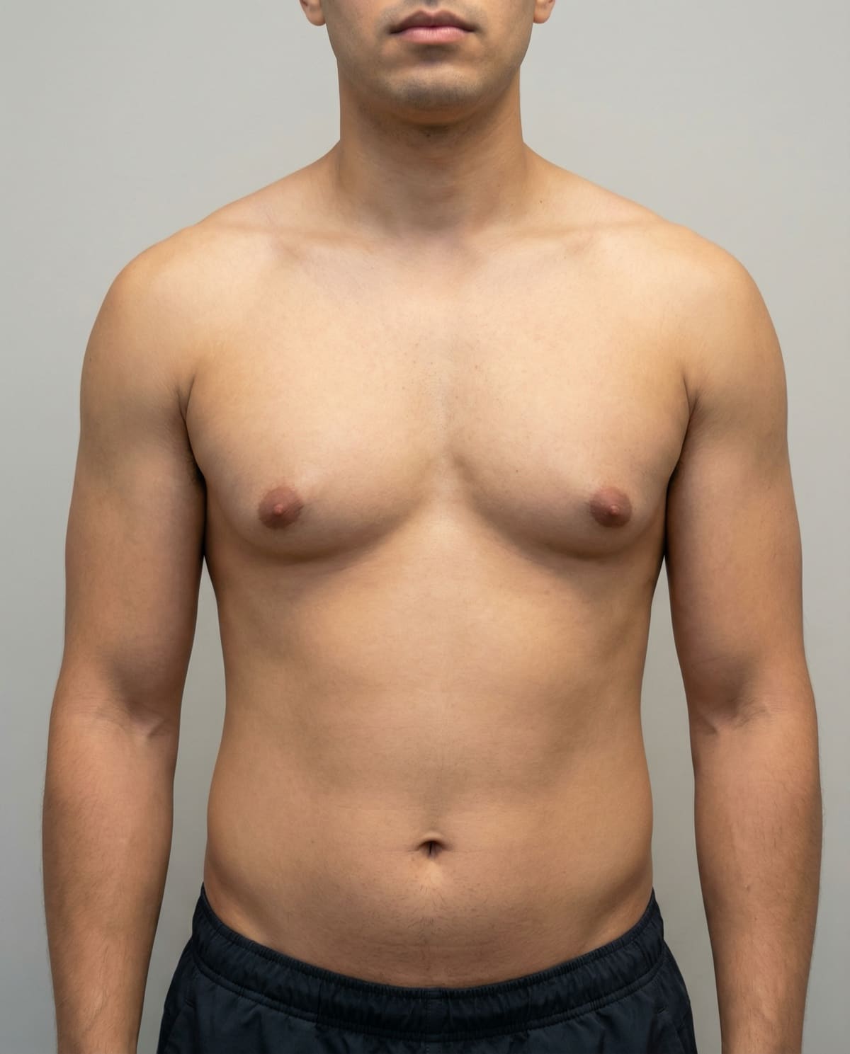 causes of gynecomastia: hormonal imbalance, medications, and weight gain contributing factors