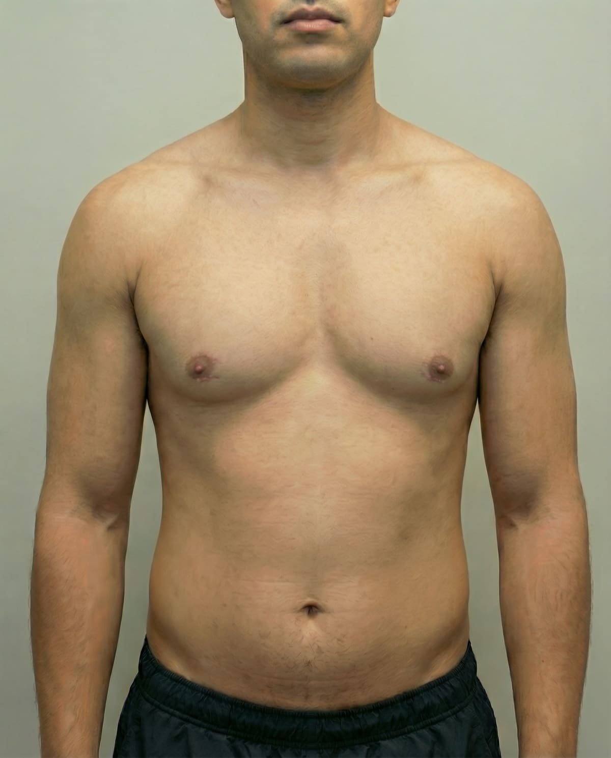 Before Tumescent Liposuction on upper back & bra line — Female patient, age 38