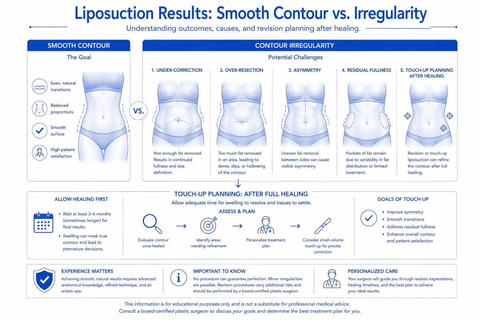 After Tumescent Liposuction on inner thighs & outer thighs — Female patient, age 29, 5 months post-op