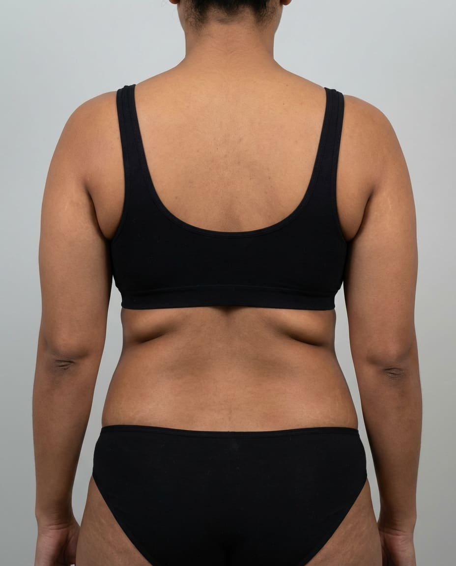 Before Tumescent Liposuction on thighs & knees — Female patient, age 35